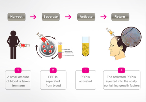 prp therapy in dubai